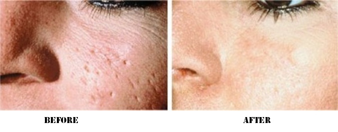 does sente dermal repair cause face to be puffy